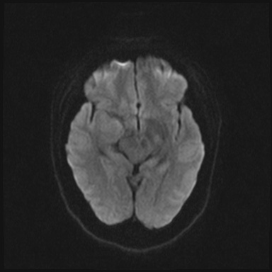 Cavernous sinus meningioma (Radiopaedia 63682-72367 DWI 51).jpg