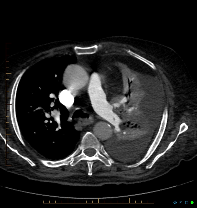 Cavitating pulmonary infarction (Radiopaedia 54634-60849 Axial C+ CTPA 29).jpg