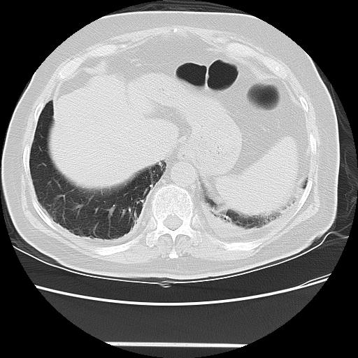 Cavitating pulmonary metastases (Radiopaedia 89545-106544 Axial lung window 48).jpg