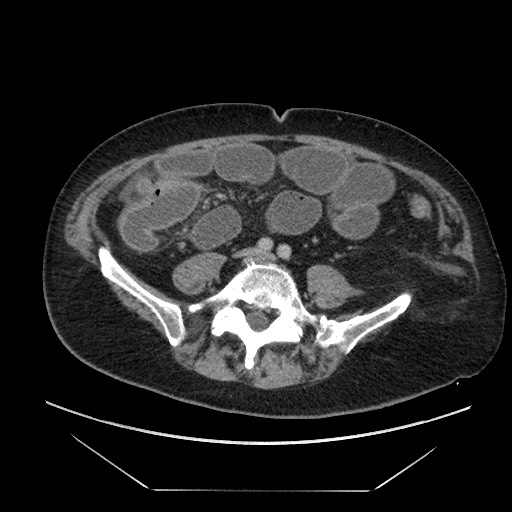Cecal adenocarcinoma (Radiopaedia 64871-73817 A 63).jpg