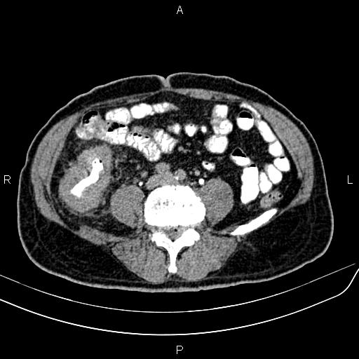 File:Cecal cancer with appendiceal mucocele (Radiopaedia 91080-108651 Axial C+ delayed 46).jpg
