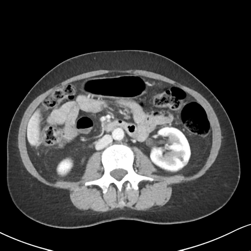 Cecal internal hernia through the foramen of Winslow (Radiopaedia 44820-48651 B 37).png