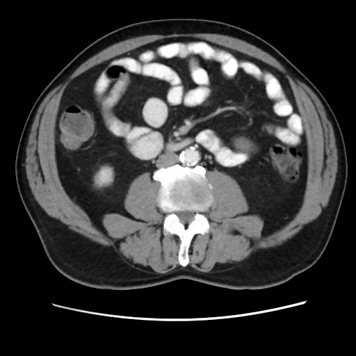 File:Cecal mass causing appendicitis (Radiopaedia 59207-66531 A 47).jpg