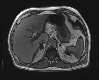 Cecal mass causing appendicitis (Radiopaedia 59207-66532 D 37).jpg
