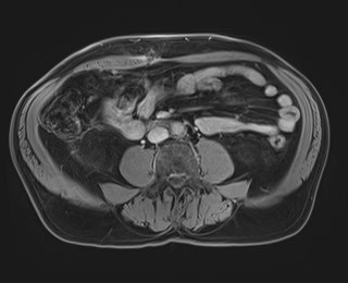 Cecal mass causing appendicitis (Radiopaedia 59207-66532 J 80).jpg