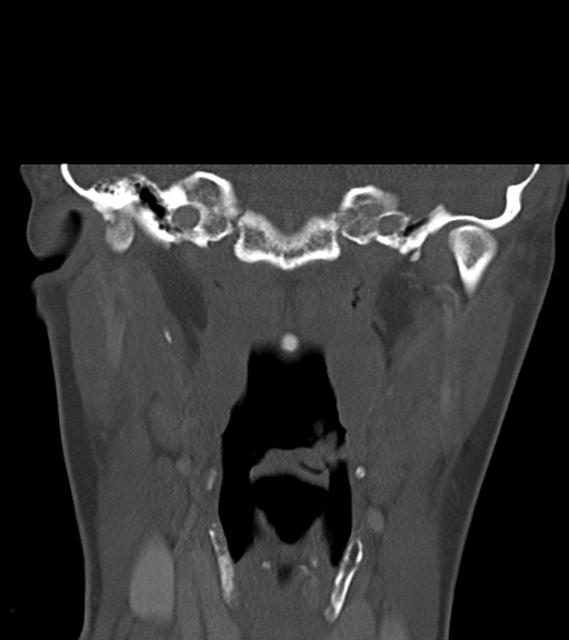 Cemento-ossifying fibroma (Radiopaedia 46243-50643 Coronal bone window 38).png