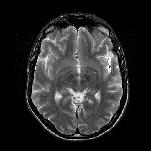 File:Central-variant posterior reversible encephalopathy syndrome (PRES) (Radiopaedia 43880-47359 Axial T2 10).jpg