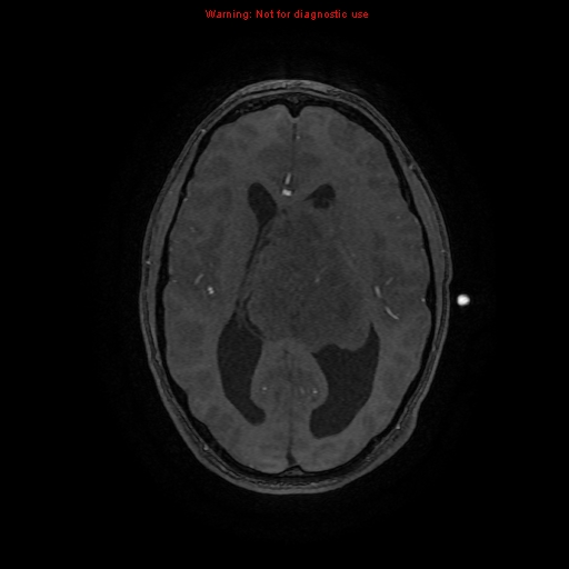 Central neurocytoma (Radiopaedia 13188-13206 Axial MRA 27).jpg