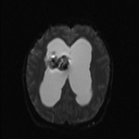 Central neurocytoma (Radiopaedia 56690-63469 Axial DWI 13).jpg