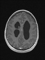 Central neurocytoma (Radiopaedia 56690-63469 Axial T1 C+ 121).jpg
