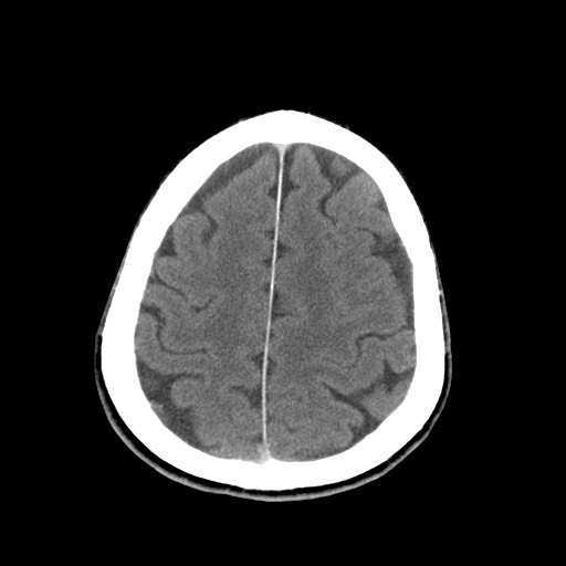 File:Central neurocytoma (Radiopaedia 68725-78432 Axial C+ 76).jpg