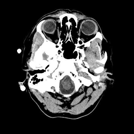 File:Central neurocytoma (Radiopaedia 68725-78432 Axial non-contrast 5).jpg