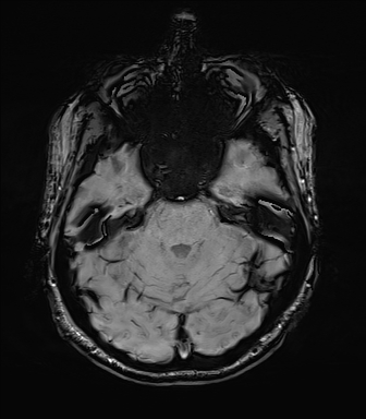 File:Central neurocytoma (Radiopaedia 71068-81303 Axial SWI 15).jpg