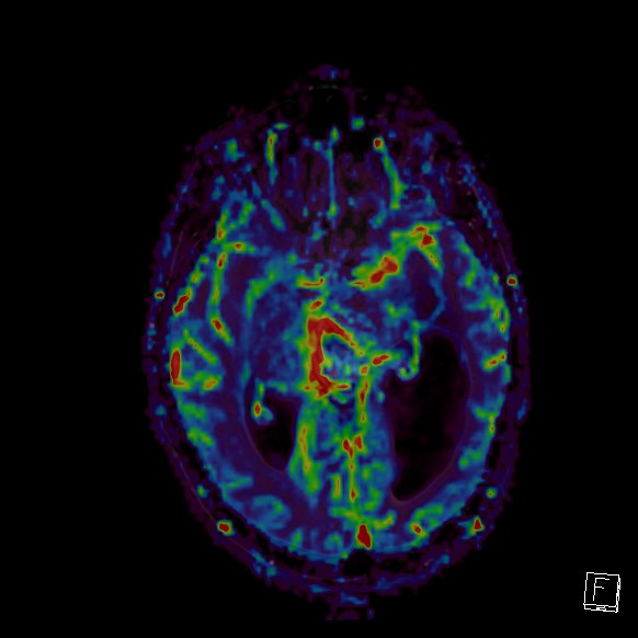 Central neurocytoma (Radiopaedia 84497-99872 Axial Perfusion 180).jpg