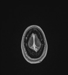 Central neurocytoma (Radiopaedia 84497-99872 Axial T1 C+ 143).jpg