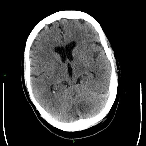 File:Cerebellar abscess (Radiopaedia 78135-90671 Axial non-contrast 51).jpg