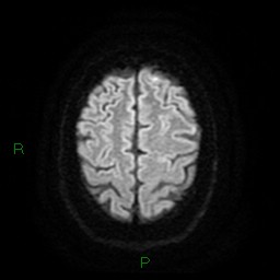 Cerebellar abscess (Radiopaedia 78135-90678 Axial DWI 24).jpg