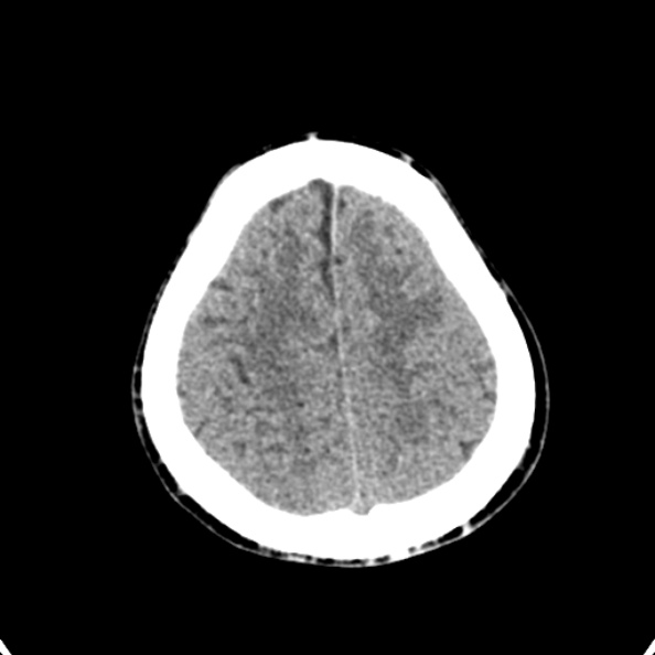 Cerebellar abscess secondary to mastoiditis (Radiopaedia 26284-26412 Axial non-contrast 134).jpg