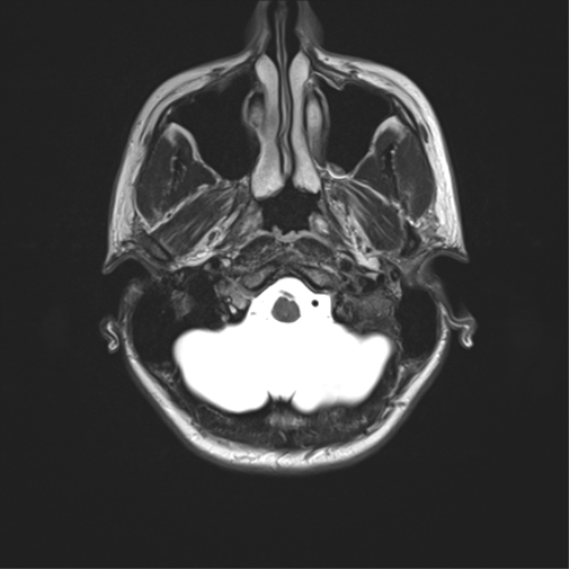 File:Cerebellar agenesis with hypoplastic pons (pontocerebellar hypoplasia) (Radiopaedia 57224-64138 Axial T2 7).png