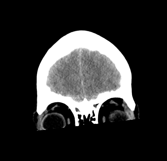 File:Cerebellar ependymoma complicated by post-operative subdural hematoma (Radiopaedia 83322-97737 Coronal non-contrast 6).png