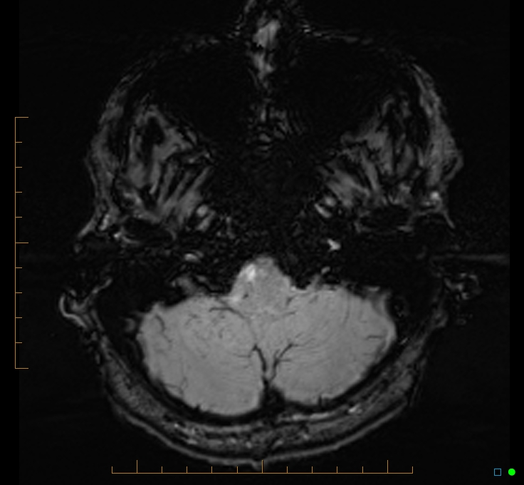 Cerebellar gangliocytoma (Radiopaedia 65377-74422 Axial SWI 8).jpg