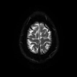 Cerebellar hemangioblastoma (Radiopaedia 29570-30077 Axial DWI 50).jpg