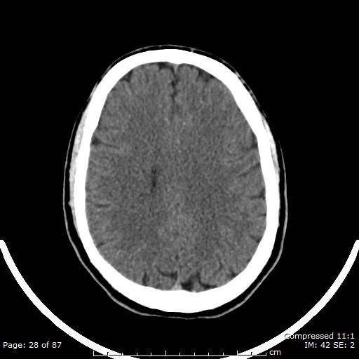Cerebellar hemangioblastoma (Radiopaedia 52360-58258 Axial non-contrast 28).jpg