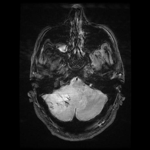File:Cerebellar hemangioblastoma (Radiopaedia 88055-104622 Axial Gradient Echo 4).jpg