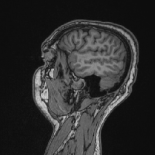 Cerebellar hemangioblastomas and pituitary adenoma (Radiopaedia 85490-101176 Sagittal T1 30).png