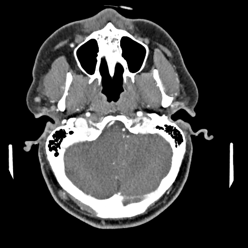 Cerebellar infarct due to vertebral artery dissection with posterior fossa decompression (Radiopaedia 82779-97029 C 33).png