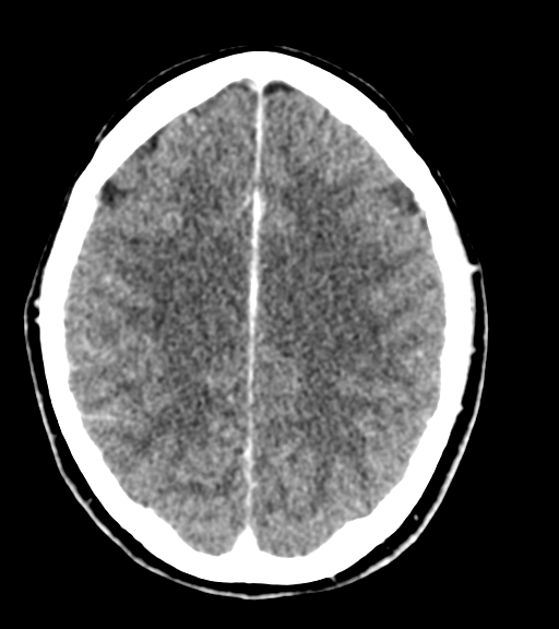 Cerebellar metastases - colorectal adenocarcinoma (Radiopaedia 40947-43652 Axial C+ 43).png