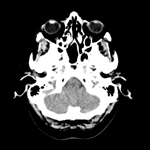 Cerebellar metastasis (Radiopaedia 54578-60812 Axial non-contrast 8).png