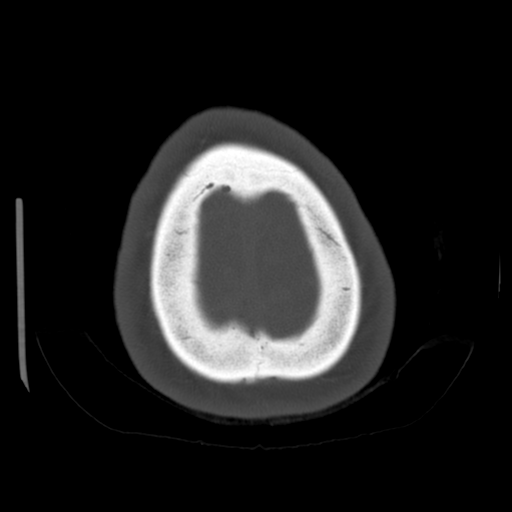 Cerebellar metastasis (cystic appearance) (Radiopaedia 41395-44258 Axial bone window 67).png