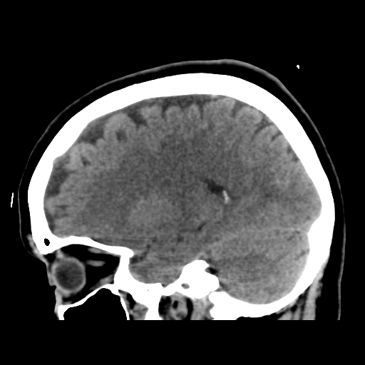 File:Cerebellar metastasis (cystic appearance) (Radiopaedia 41395-44258 E 22).png