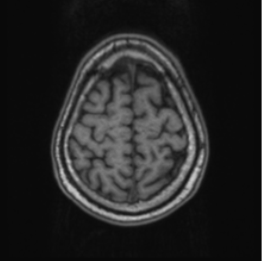 Cerebellar metastasis from lung adenocarcinoma (Radiopaedia 86690-102829 Axial T1 68).png