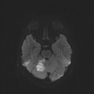 File:Cerebellar stroke (Radiopaedia 32202-33150 Axial DWI 31).png