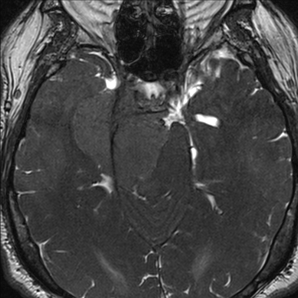 Cerebellopontine angle meningioma (Radiopaedia 24459-24764 I 34).jpg