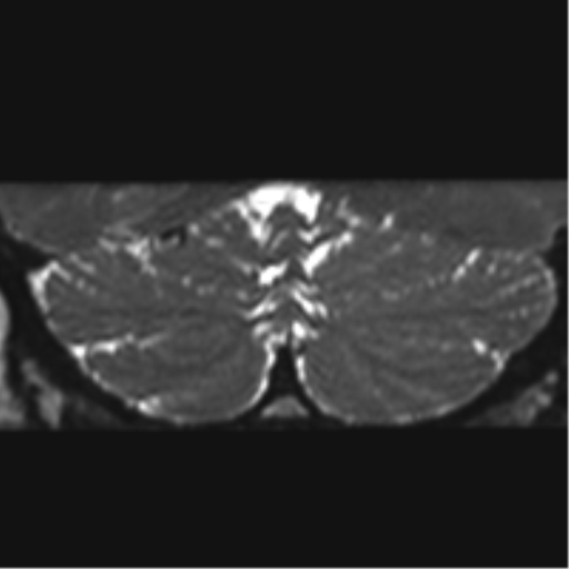 Cerebellopontine angle meningioma (Radiopaedia 48434-53348 Coronal T2 1).png