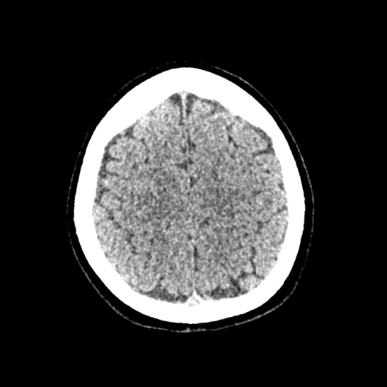 Cerebellopontine angle meningioma (Radiopaedia 53561-59592 Axial non-contrast 54).jpg
