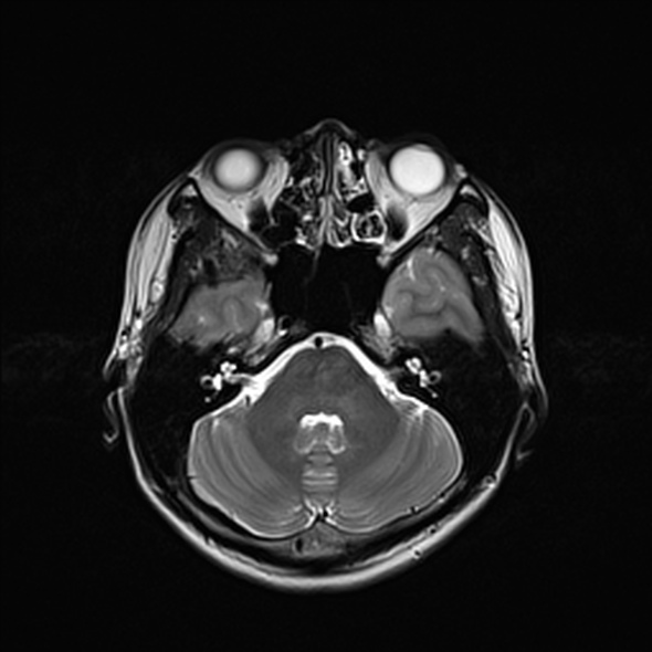 Cerebral abscess (Radiopaedia 24212-24478 Axial T2 20).jpg