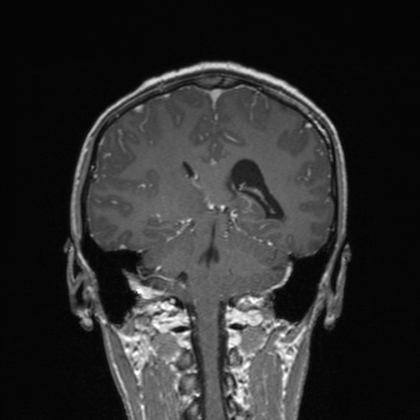 Cerebral abscess (Radiopaedia 24212-24478 Coronal T1 C+ 134).jpg