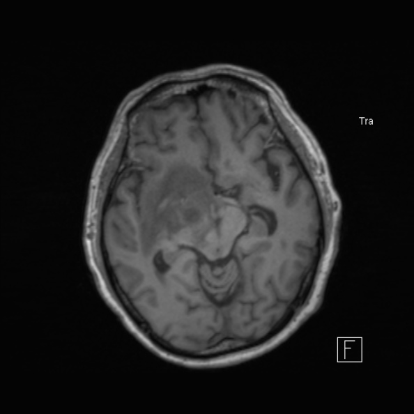 Cerebral abscess (Radiopaedia 26111-26247 Axial T1 28).jpg