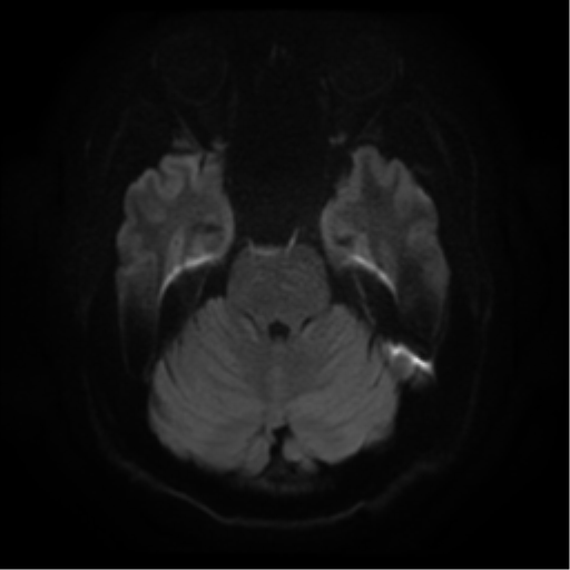 File:Cerebral abscess (Radiopaedia 57774-64740 Axial DWI 8).png