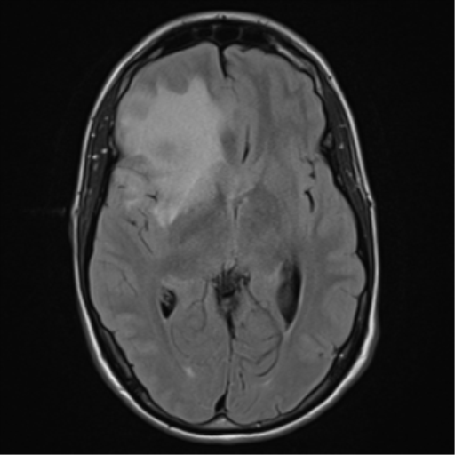 File:Cerebral abscess (Radiopaedia 60342-68009 Axial FLAIR 14).png