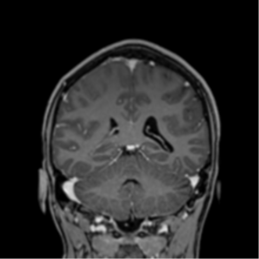 Cerebral abscess (Radiopaedia 60342-68009 H 15).png