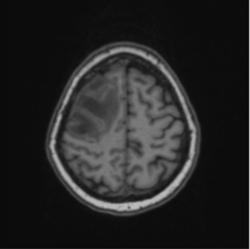 Cerebral abscess from pulmonary arteriovenous malformation (Radiopaedia 86275-102291 Axial T1 60).png
