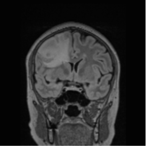 Cerebral abscess from pulmonary arteriovenous malformation (Radiopaedia 86275-102291 Coronal FLAIR 56).png