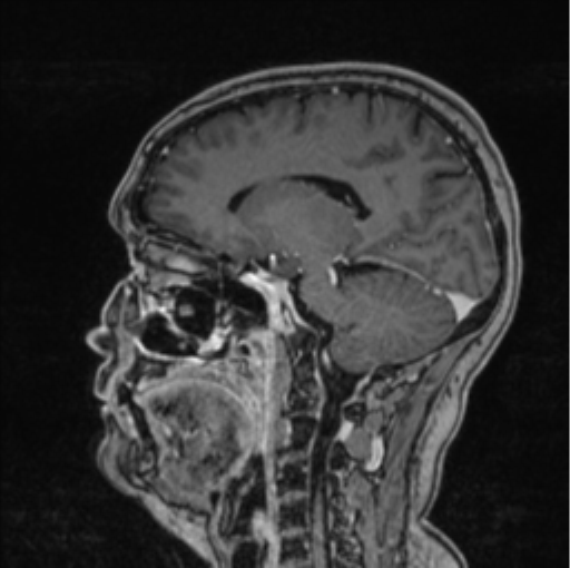Cerebral abscess from pulmonary arteriovenous malformation (Radiopaedia 86275-102291 Sagittal T1 C+ 33).png