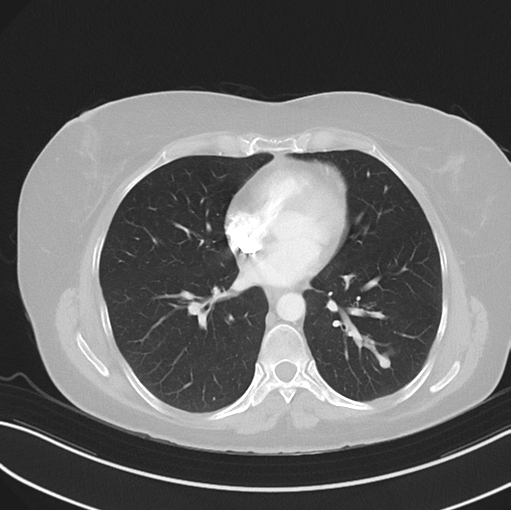 Cerebral abscess from pulmonary arteriovenous malformation (Radiopaedia 86275-102292 Axial lung window 35).png