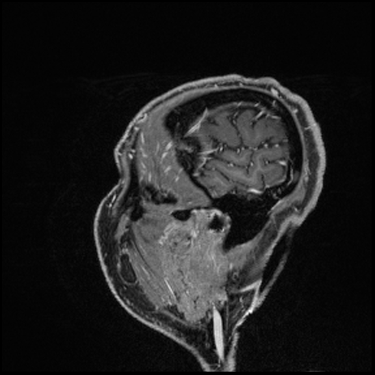 Cerebral abscess with ventriculitis (Radiopaedia 78965-91878 Sagittal T1 C+ 161).jpg